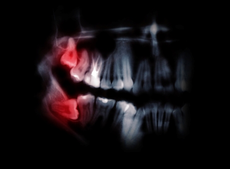 Why Wisdom Teeth Often Need to Be Removed