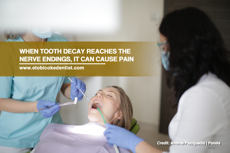 When tooth decay reaches the nerve endings, it can cause pain
