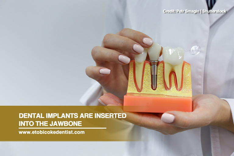 Dental implants are inserted into the jawbone