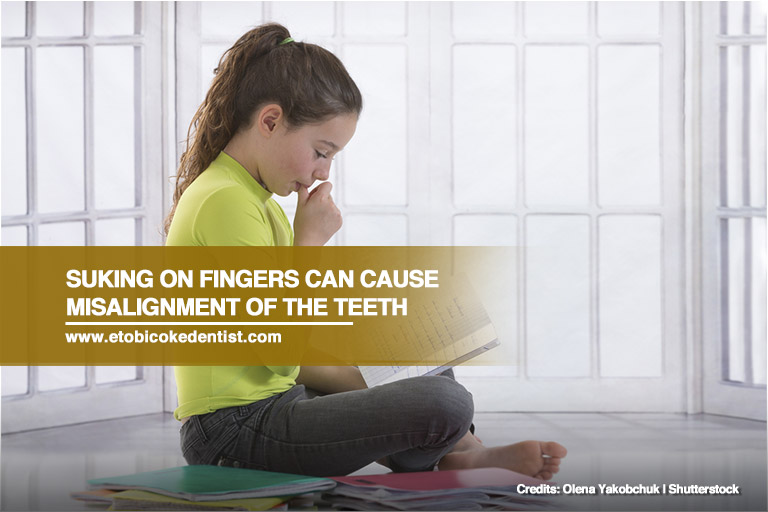 Suking on fingers can cause misalignment of the teeth